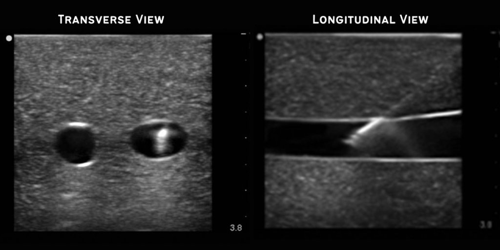 Ultrasound Guided IV Example Views